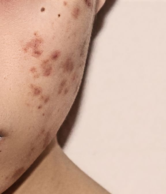 acne scars