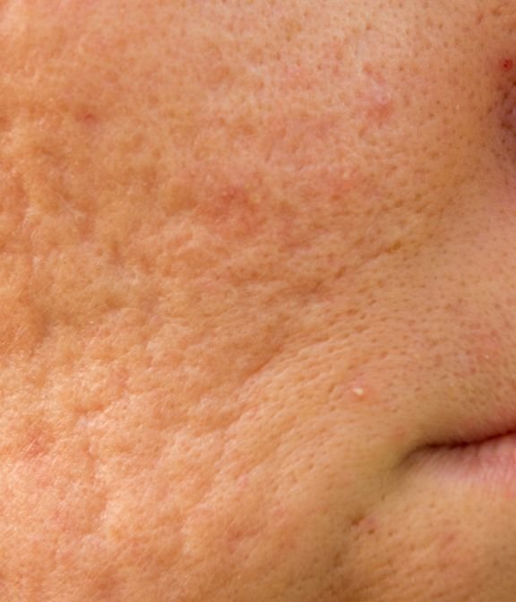 pores