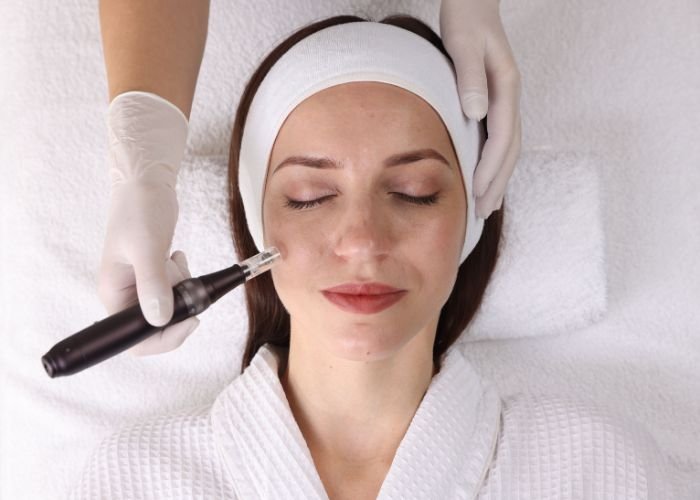 Skin needling perth